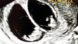 赤ちゃんの成長とエコー写真（妊娠初期）