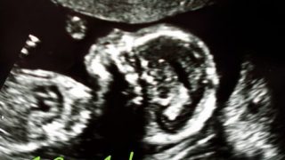 赤ちゃんの成長とエコー写真（妊娠中期）